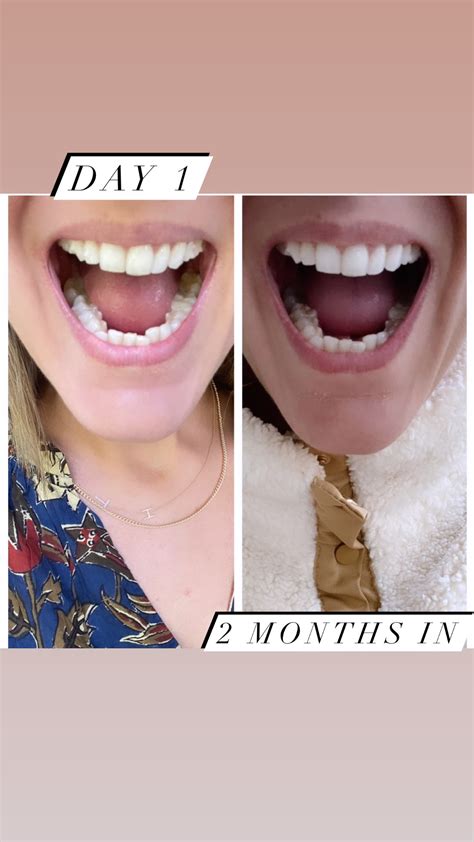 invisalign results after 1 month|problems with invisalign results.